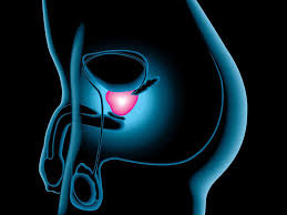 Enlarged prostate
